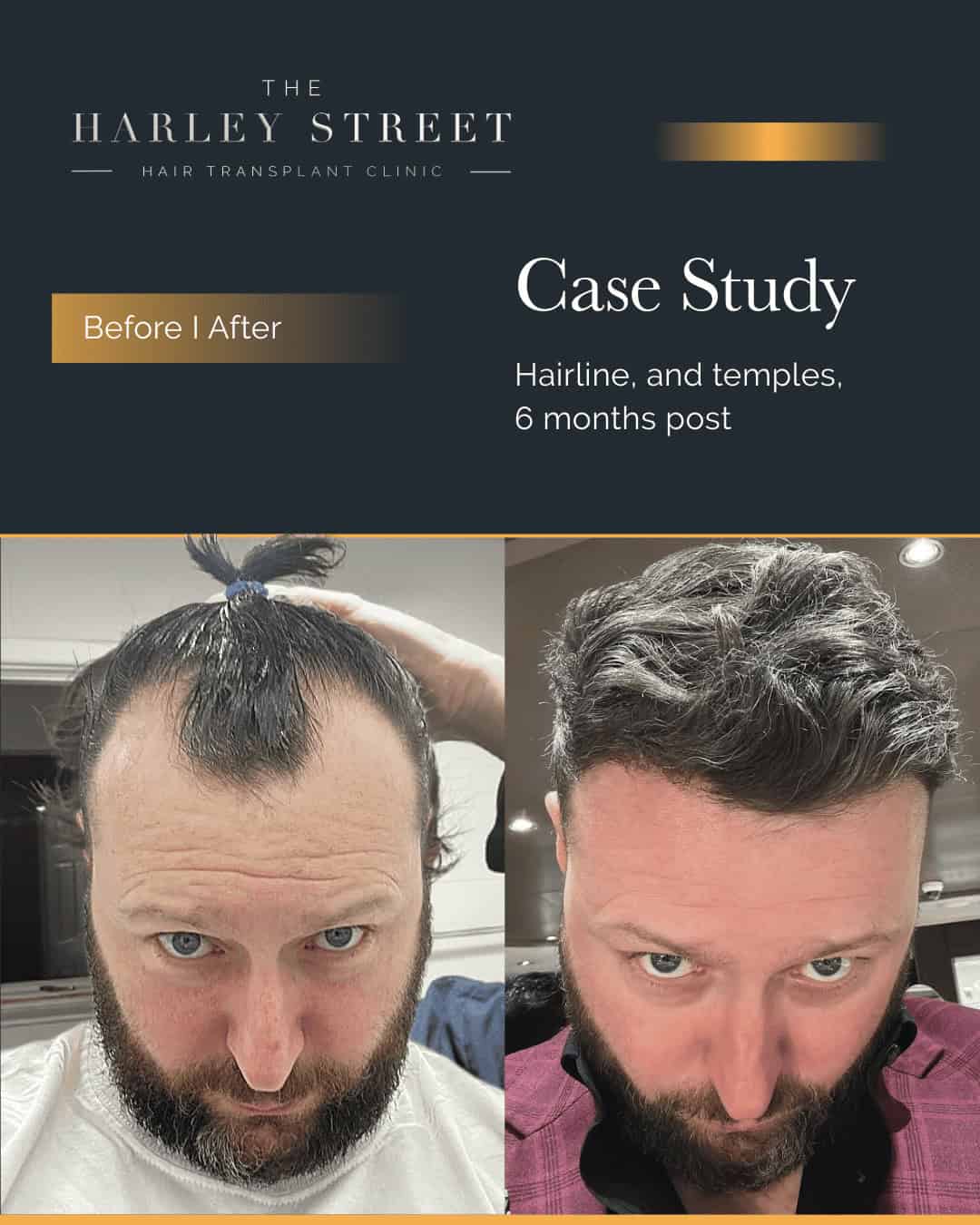 Harley Street HT pt Gerard Walsh hairline