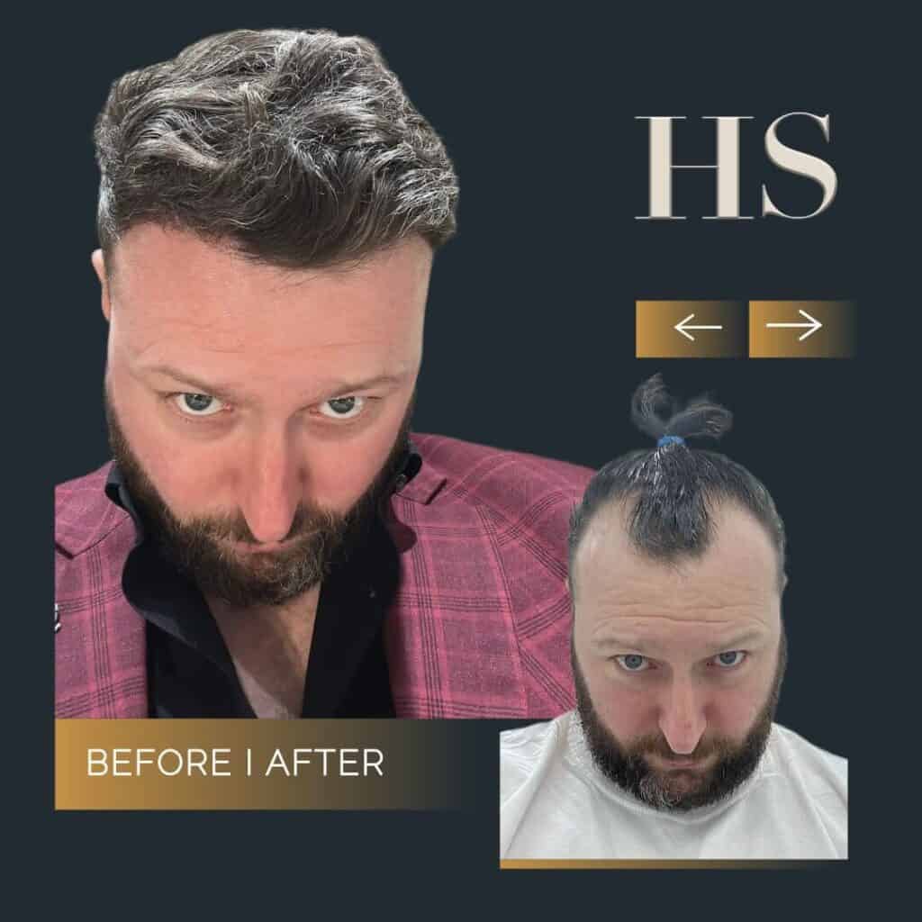 Harley Street Hair Transplant Clinics London Home Page Harley Street HT pt Gerard before and after