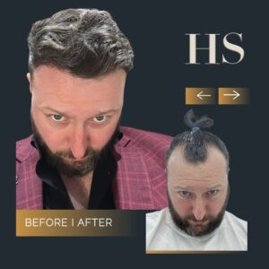 Hairline Hair Transplant Harley Street HT pt Gerard before and after