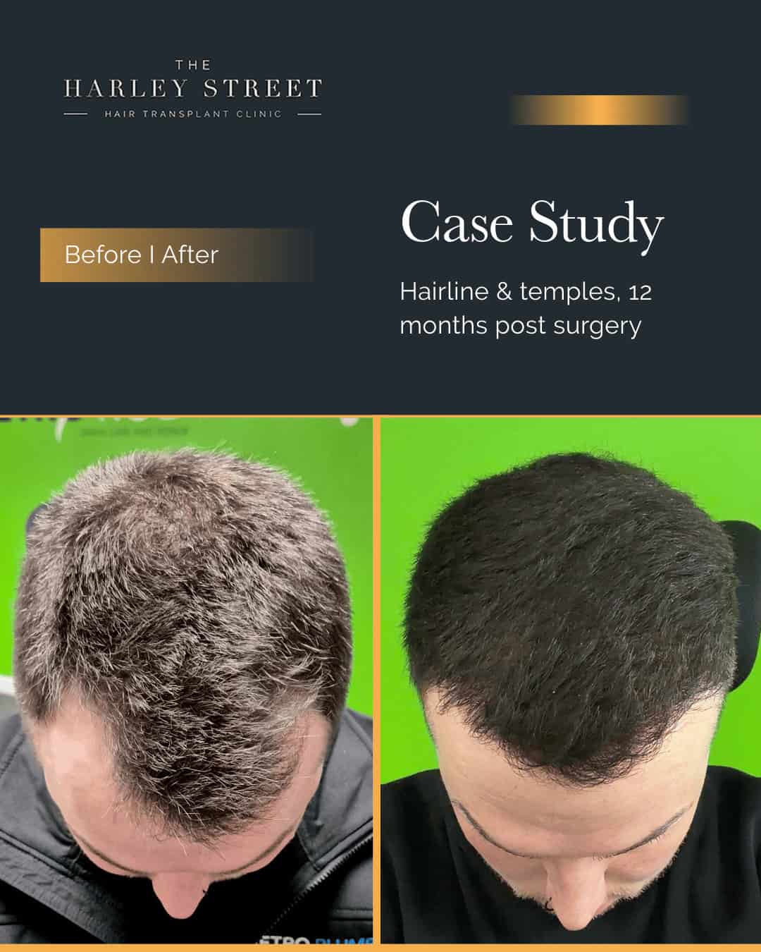 Widow's Peak Hair Transplant Harley Street HT pt Gill hairline