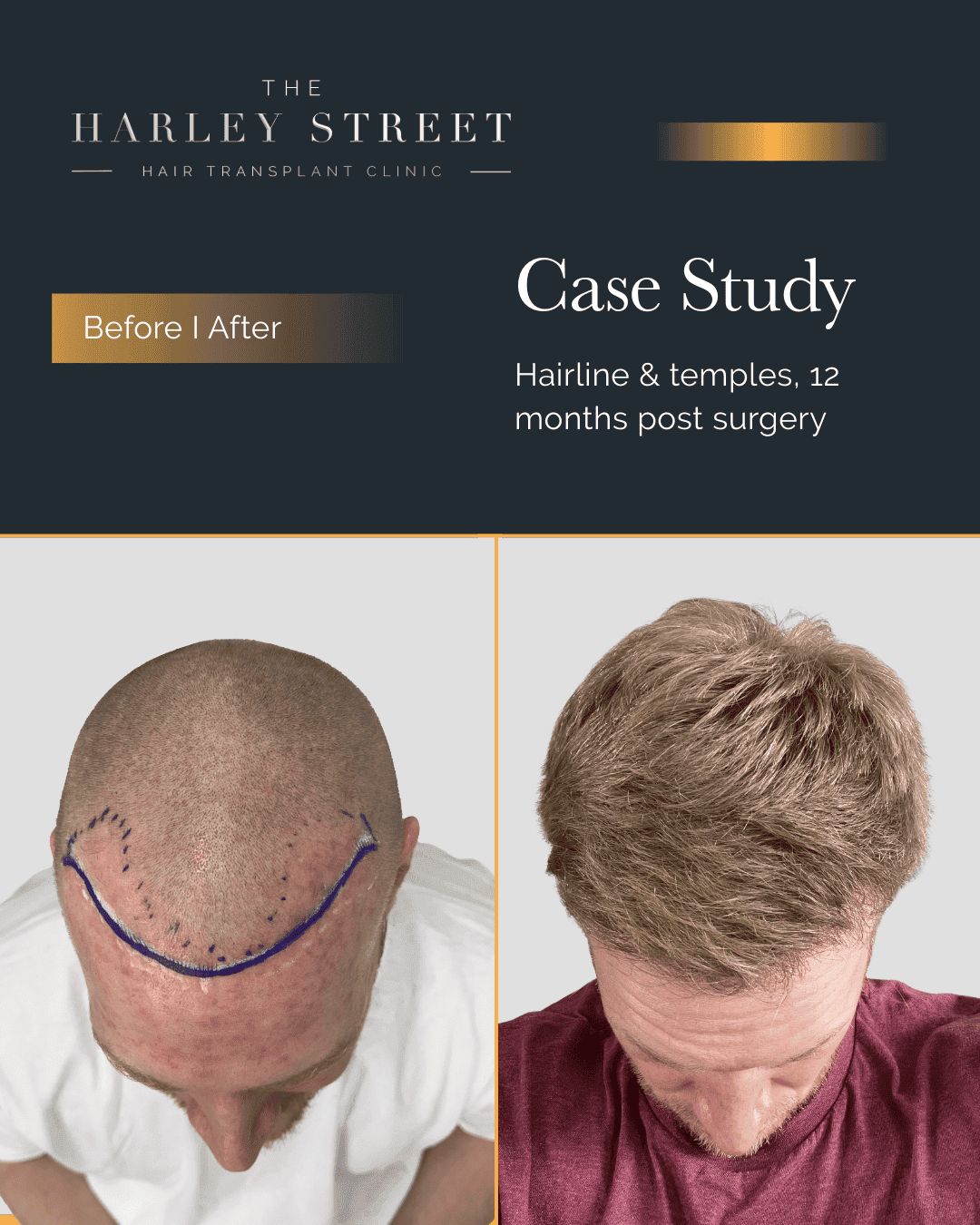 Harley Street HT pt Kirkpatrick hairline aerial