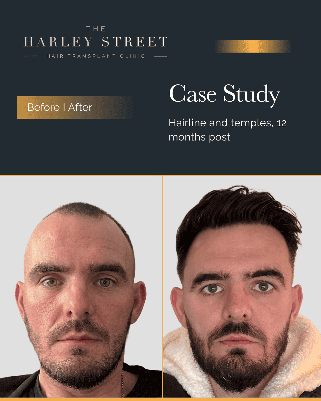 Harley Street HT pt Ryan frontal 3rd hairline
