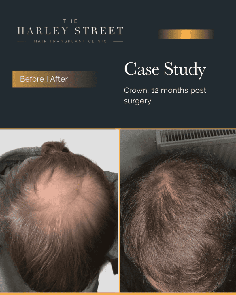Sheffield Hair Transplant Clinic Harley Street HT pt, Wagstaff, crown