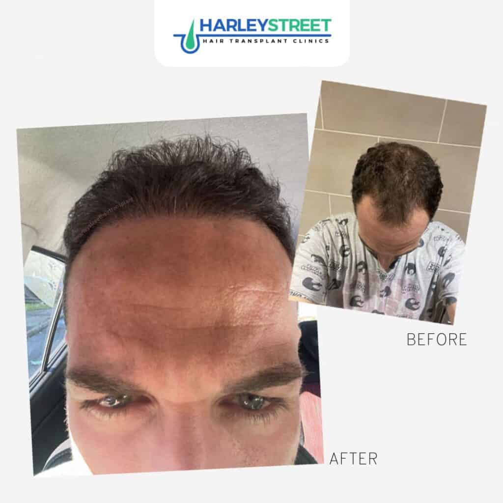 Hair Transplant Aftercare Harley Street Hair Transplant Clinics Patient with hairline recession before and after