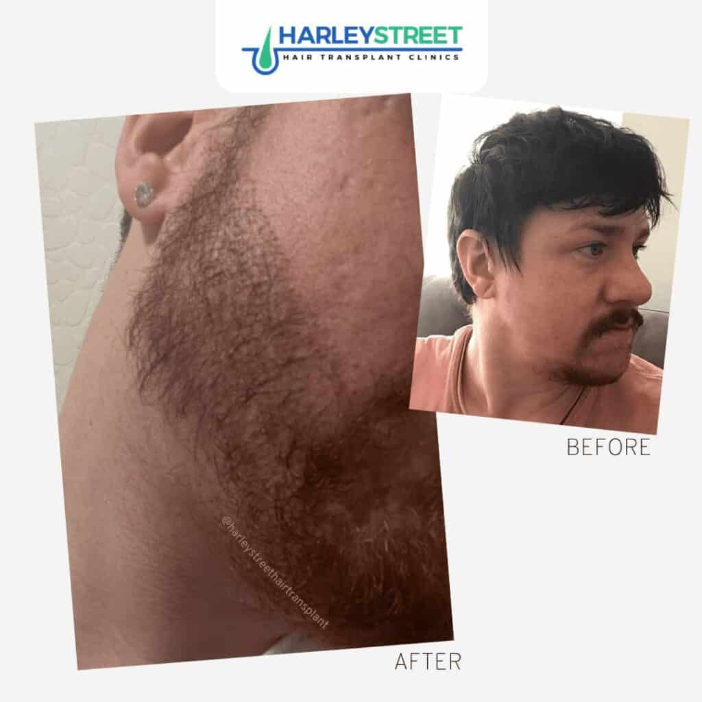 Harley Street Hair Transplant Clinics beard transplant patient before and after