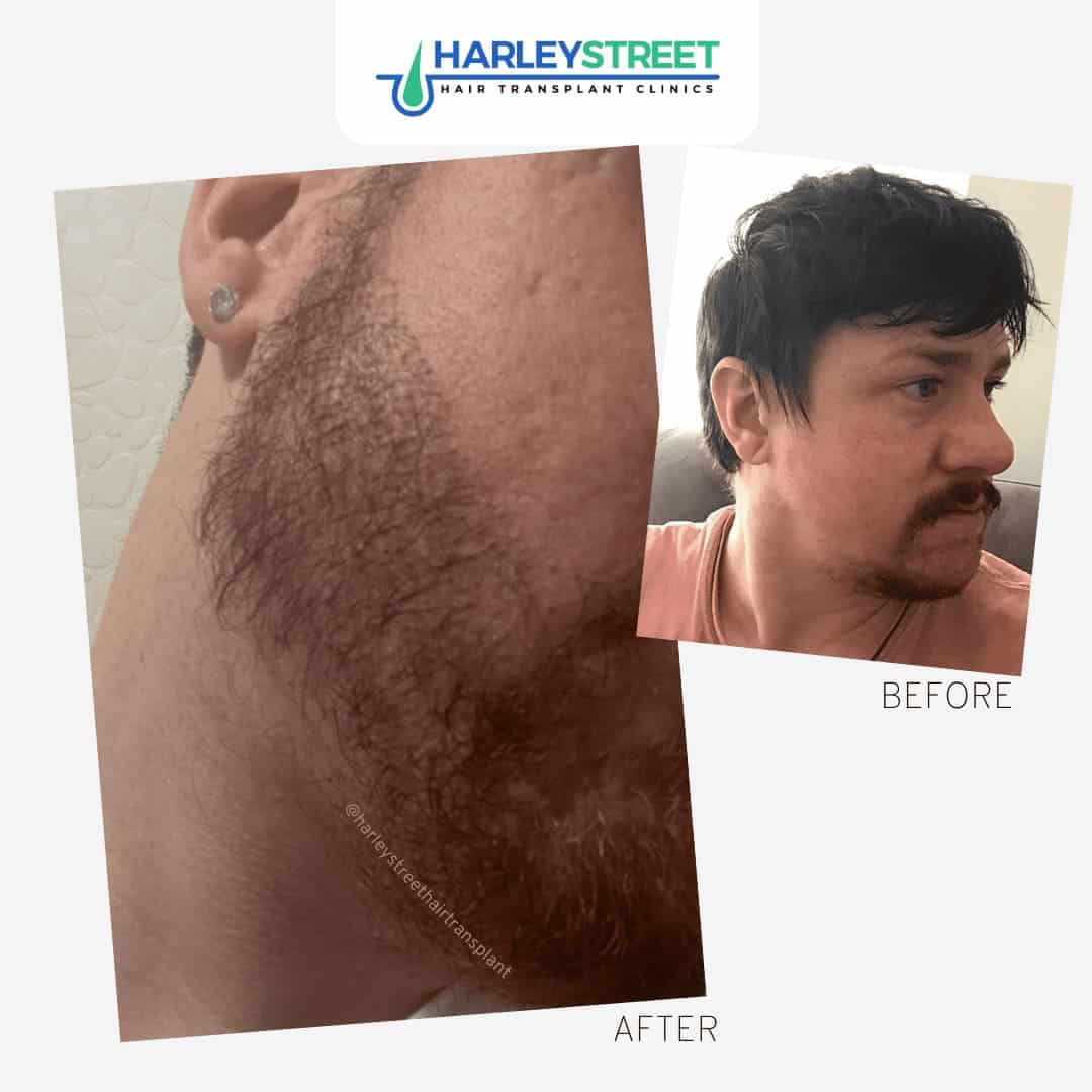 Beard Transplant Liverpool Harley Street Hair Transplant Clinics beard transplant patient before and after