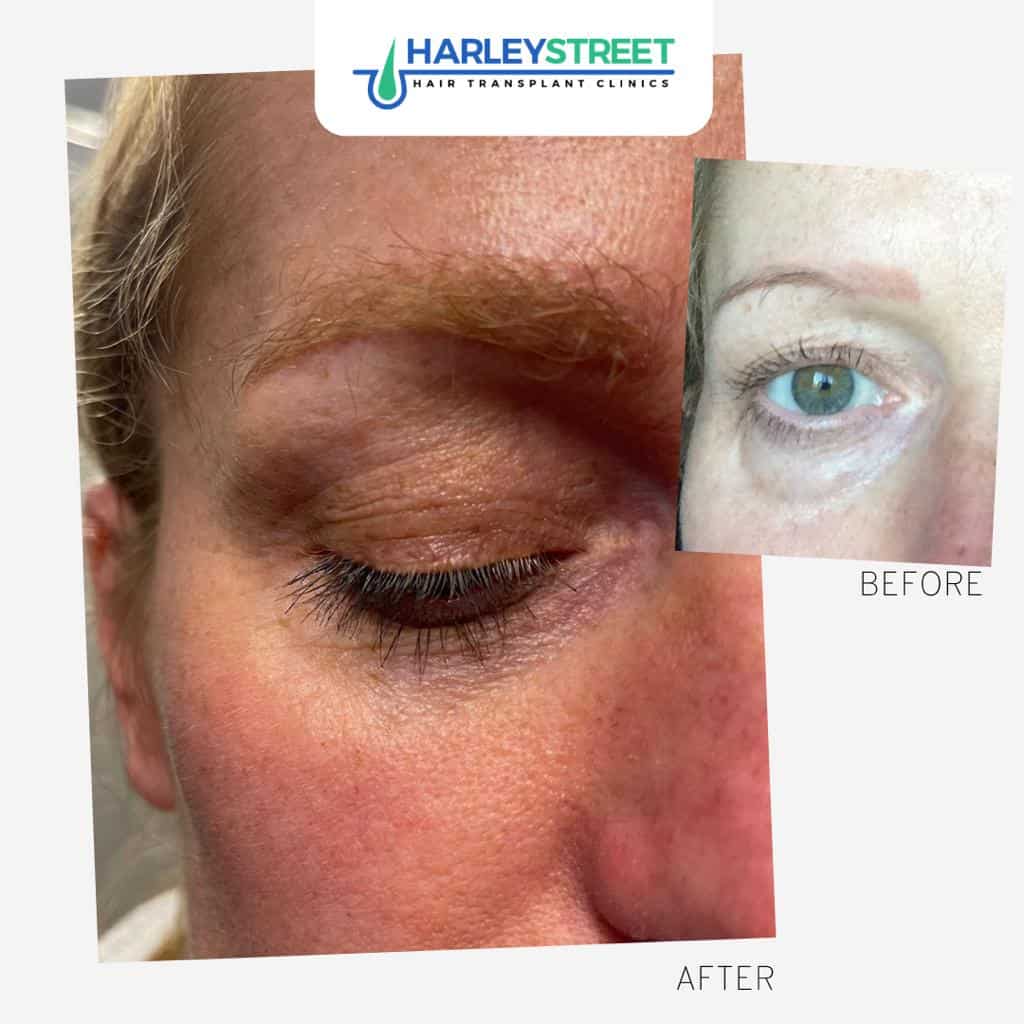 Harley Street Hair Transplant Clinics female patient eyebrow transplant before and after