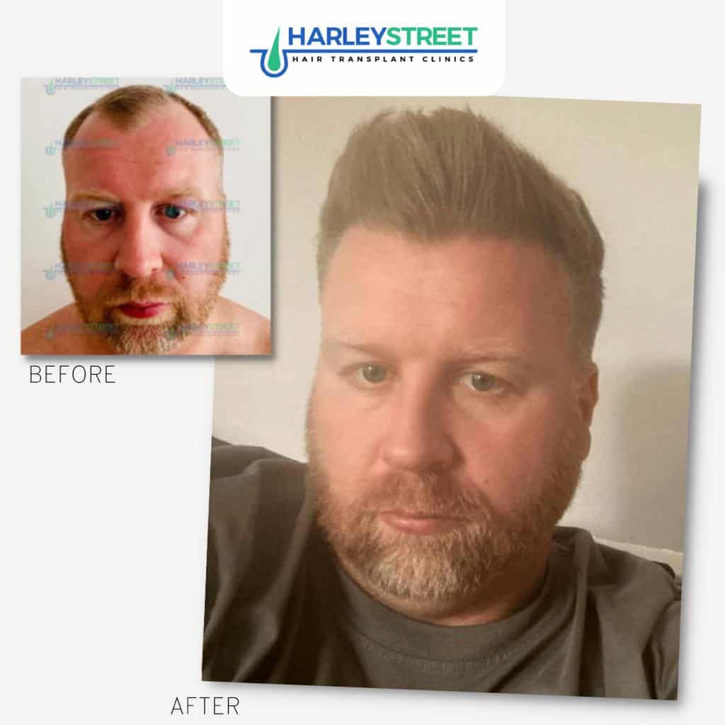 Harley Street Hair Transplant Clinics patient Aaron before and after