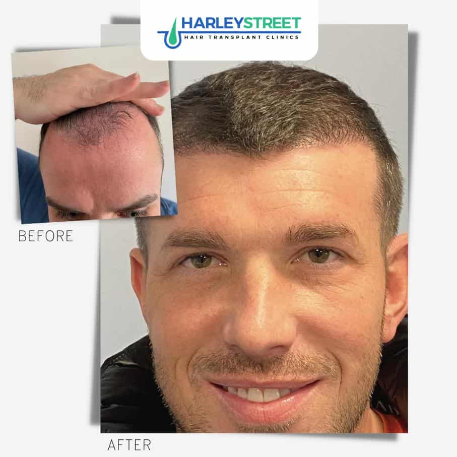 Before and After Results Harley Street Hair Transplant Clinics patient before and after