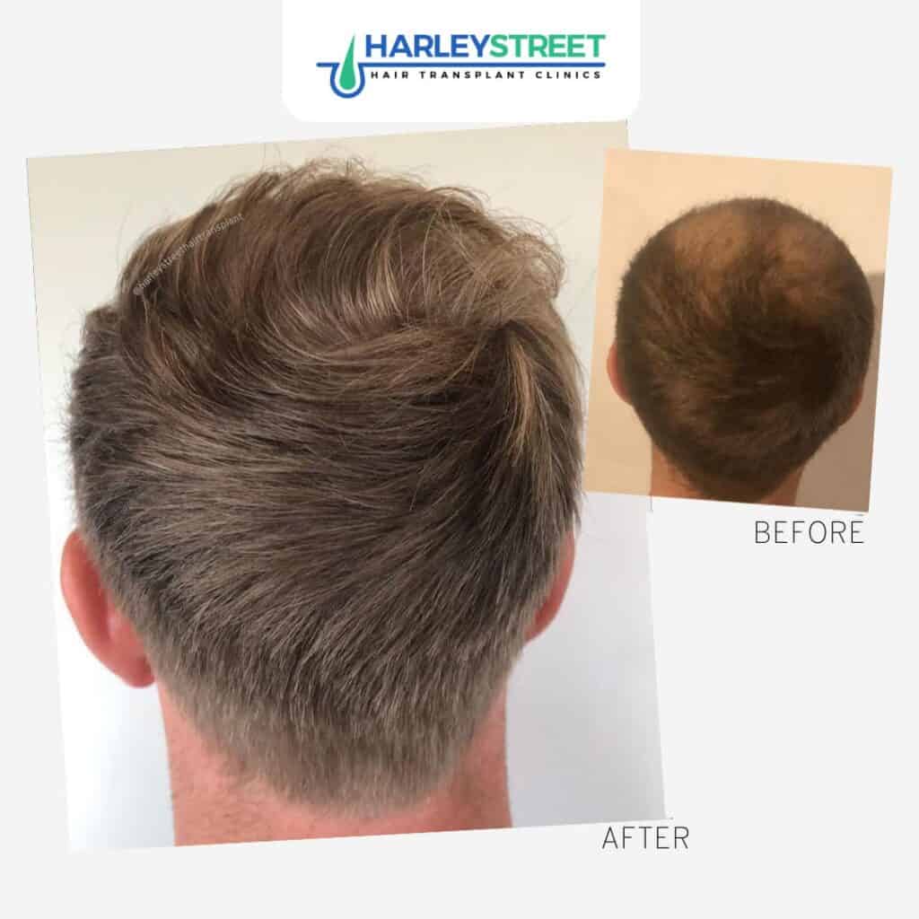 Harley Street Hair Transplant Clinics patient with crown recession before and after procedure