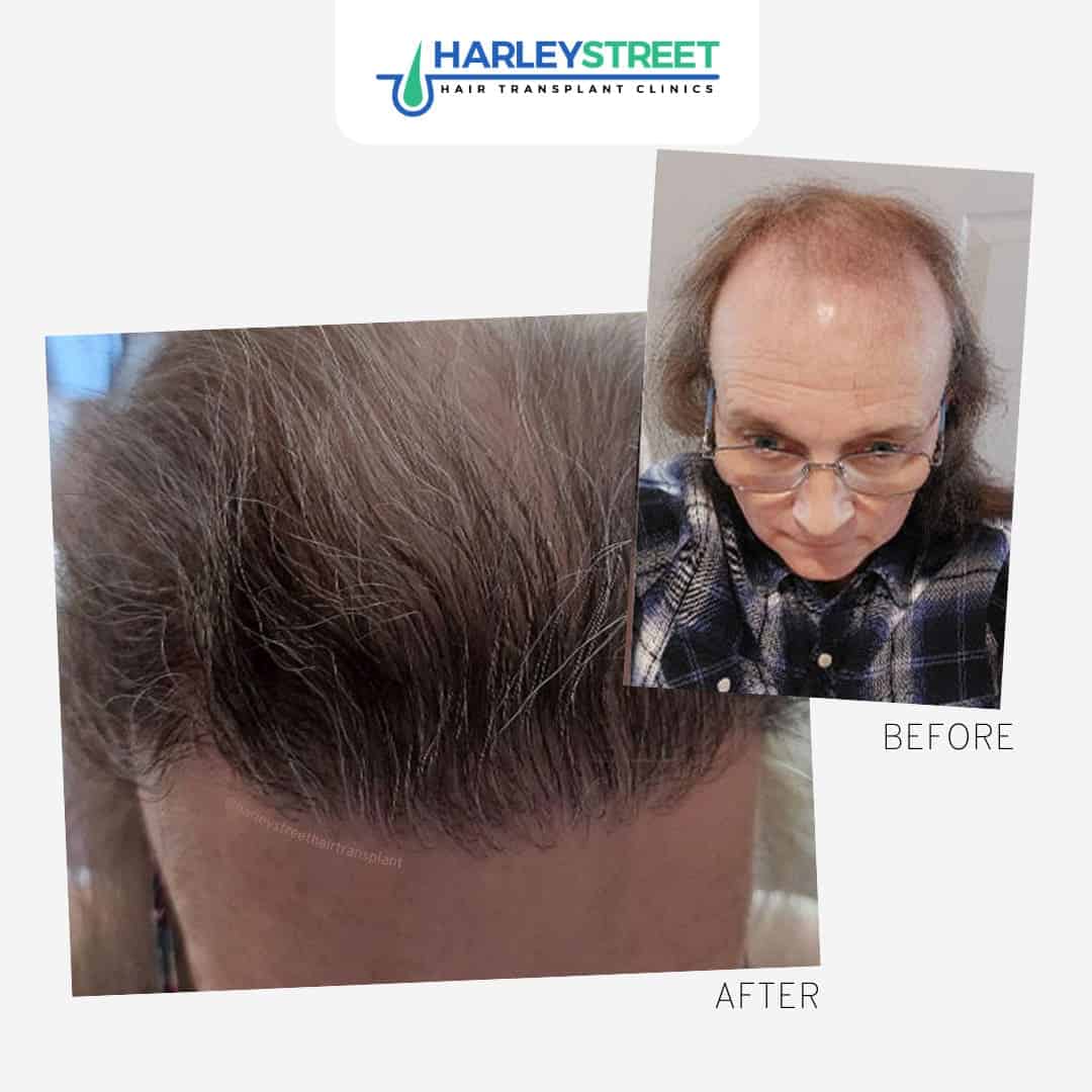 Harley Street Hair Transplant Clinics patient with lots of hair loss before and after