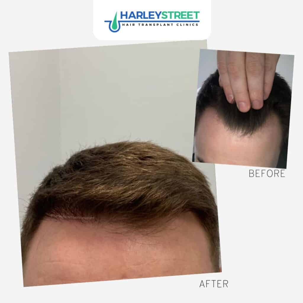 Harley Street Hair Transplant Clinics patient with small hairlines recession before and after