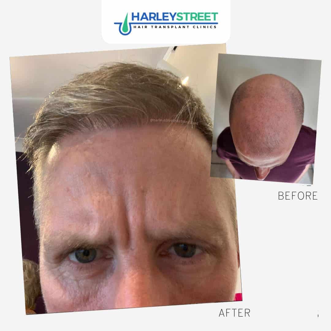Hair Transplant Aftercare Harley Street Hair Transplant Clinics patient with top of head hair loss before and after