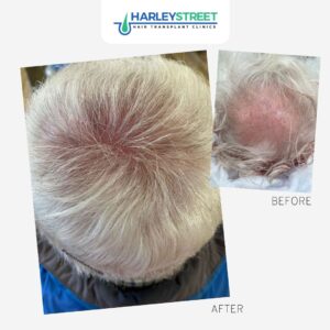 Hair Transplant Cost UK Harley Street Ht Clinics before and after crown older man