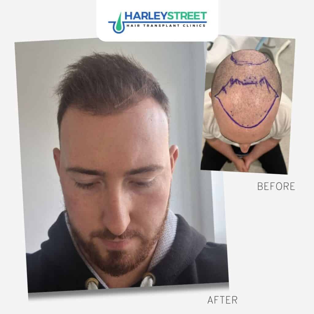 Hair Transplant Before and After Results Harley Street before and after hairline area