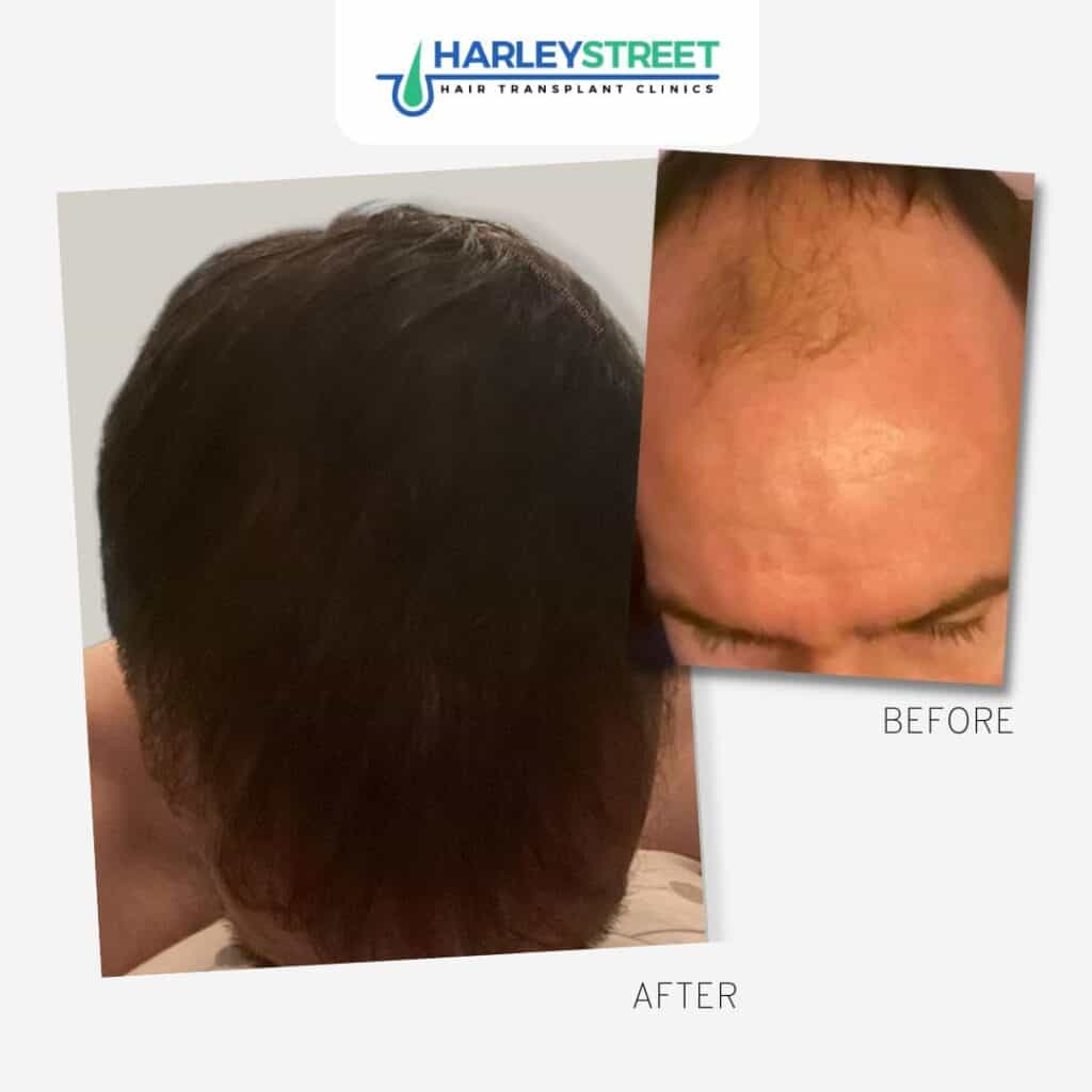 Harley Street before and after tom