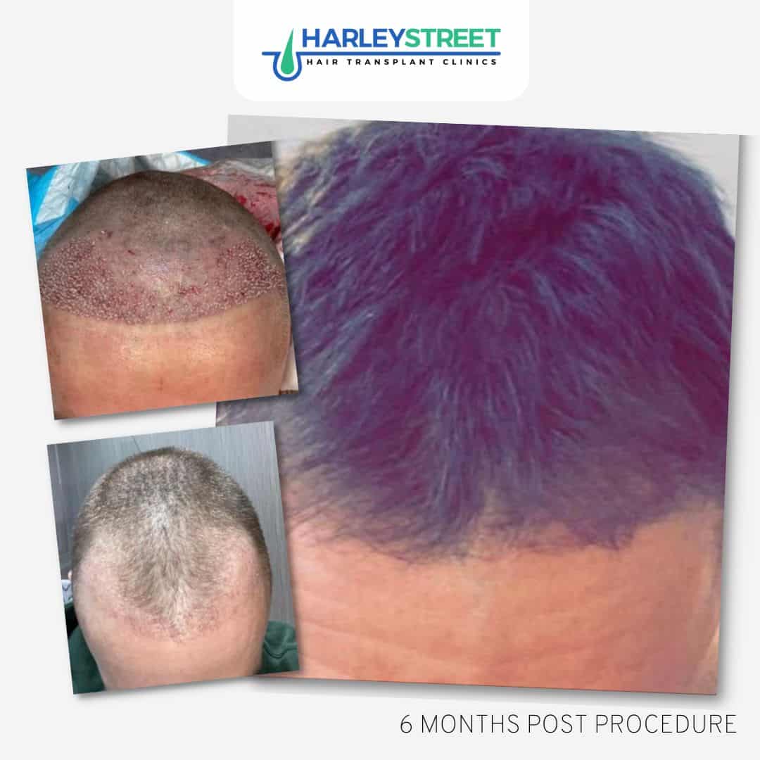 Mark 6 months post procedure 2000 grafts