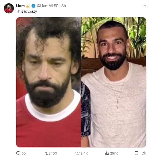 Mo Salah before and after hair transplant