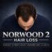 Norwood 2 Hair Loss Guide