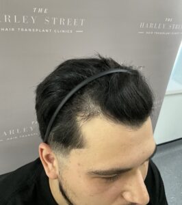 Norwood 2 hair loss