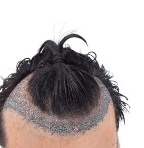 Norwood 2 post hair transplant
