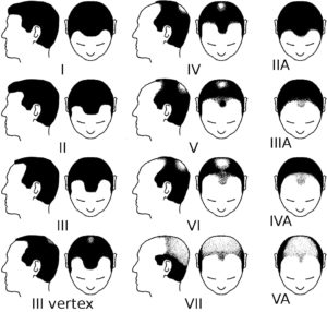 Norwood scale for male pattern baldness