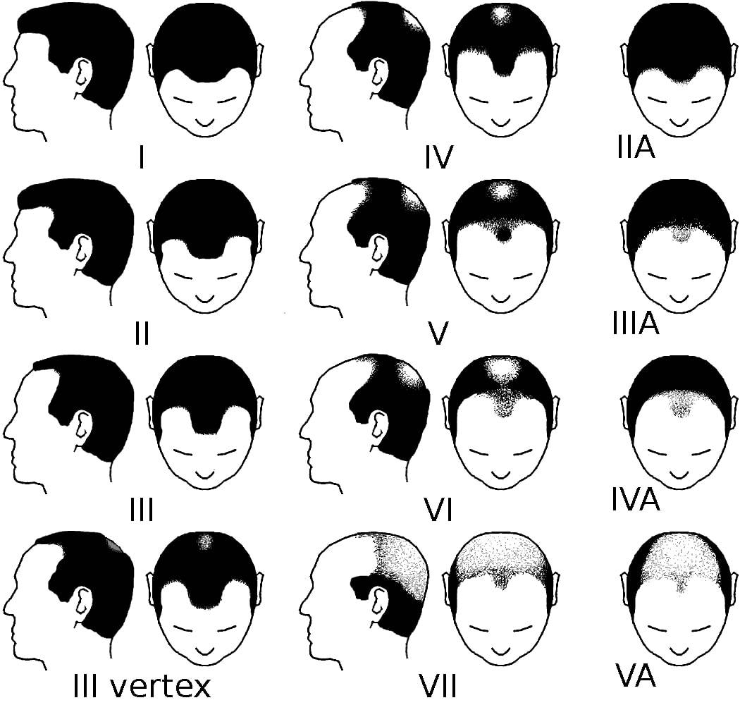 Norwood Chart Pattern Baldness