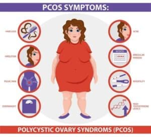 PCOS and hair loss