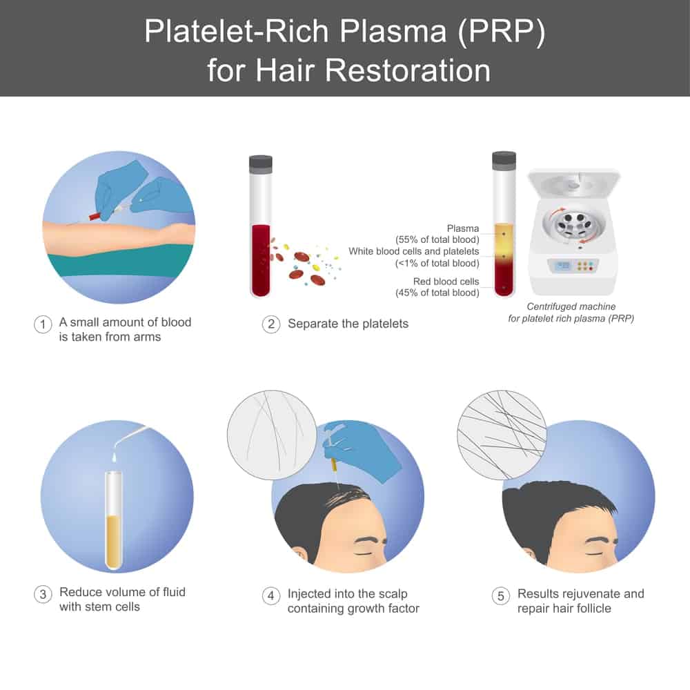 PRP Hair Treatment PRP therapy and process