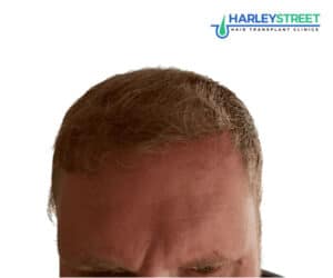 Hair Transplant Before and After Results Paul_Parker_12_months_after_ht