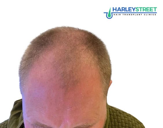 Hair Transplant Before and After Results Paul Parker before ht