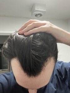 Pre surgery, frontal