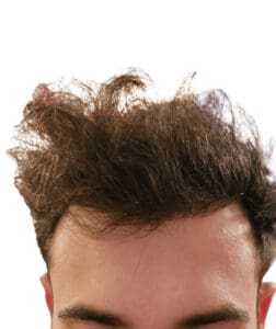 Hair Transplant Before and After Results Savvas_1_year_after_ht-removebg-preview