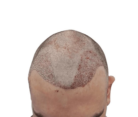 Hair Transplant Before and After Results Savvas_just_after_ht-removebg-preview