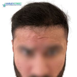 Hair Transplant Before and After Results Shreyas Malhotra 6 months