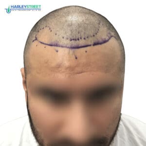 Hair Transplant Before and After Results Shreyas Malhotra Pre surgery