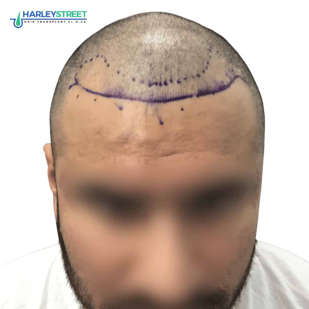 Hair Transplant Before and After Results Shreyas Malhotra Pre surgery
