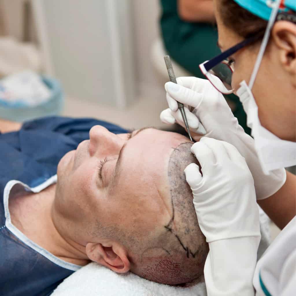 Surgeon working on male FUE hair transplant