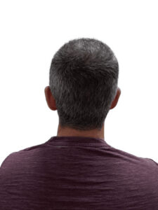 Thomas 6 months post crown ht