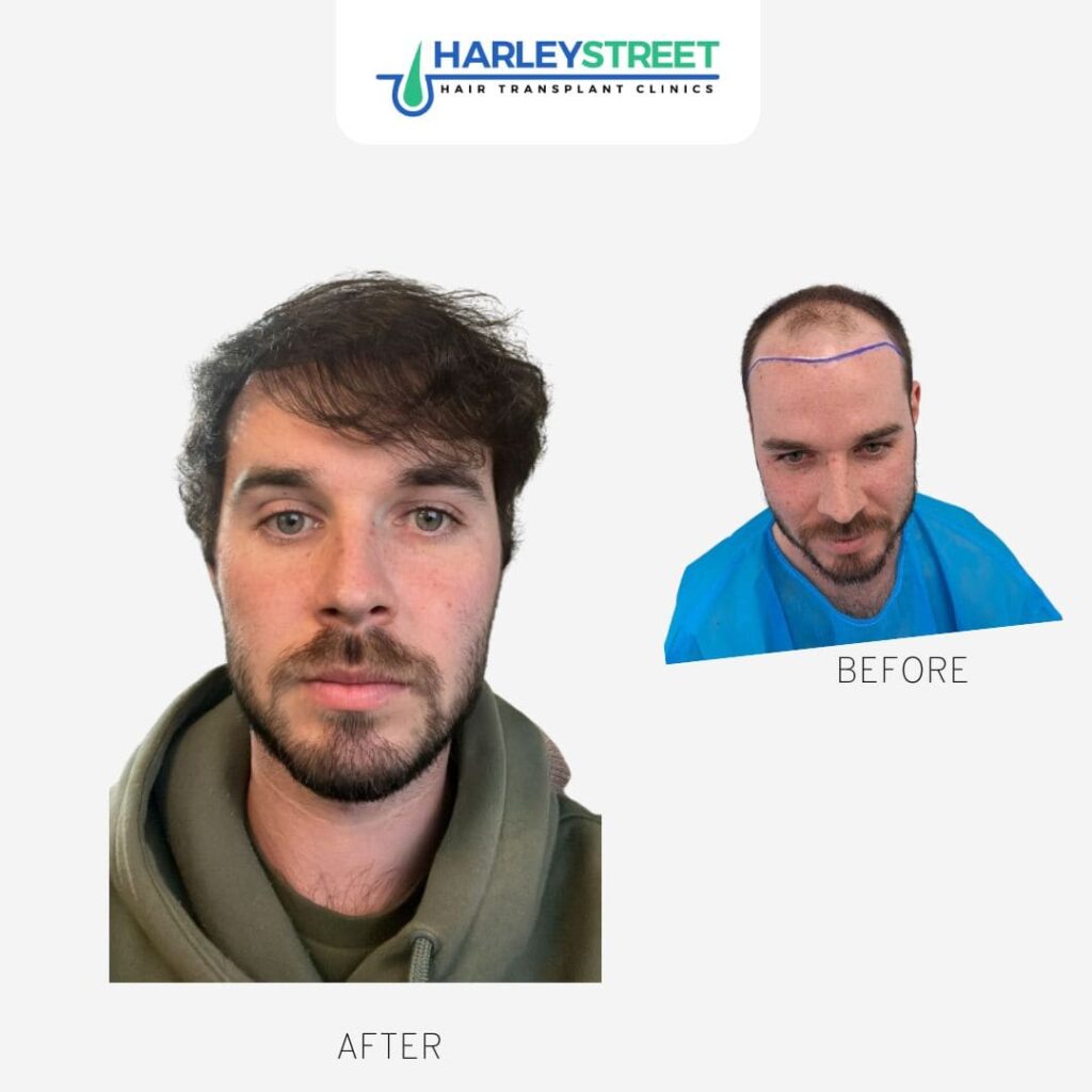 Tom Francis Before & After