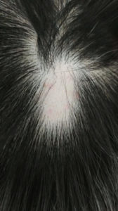 alopecia areata