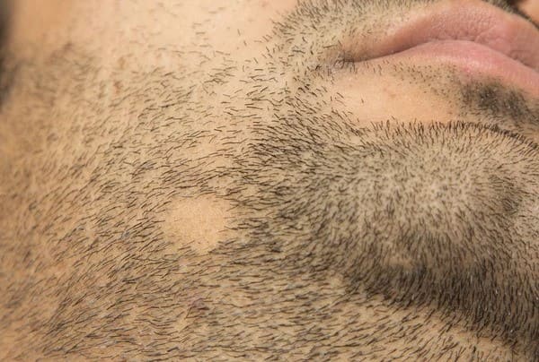 alopecia barbae patchy hair loss on beard