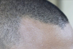 androgenetic alopecia