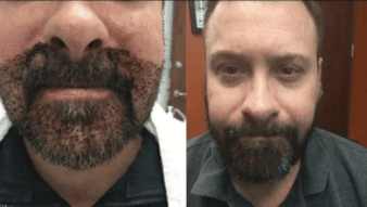 Beard Transplant beard-transplant-client