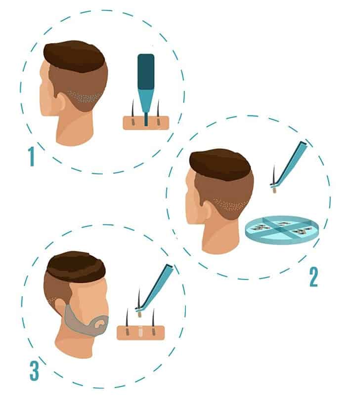 Beard Transplant beard transplant procedure and process-min