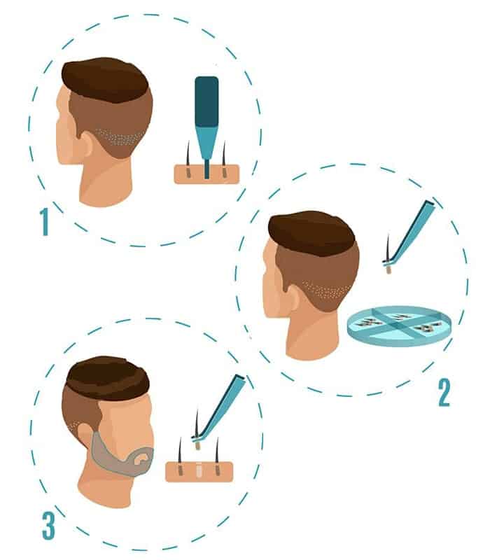 beard transplant procedure and process-min