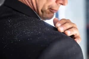 can dandruff cause hair loss