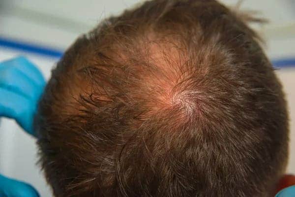 crown hair loss