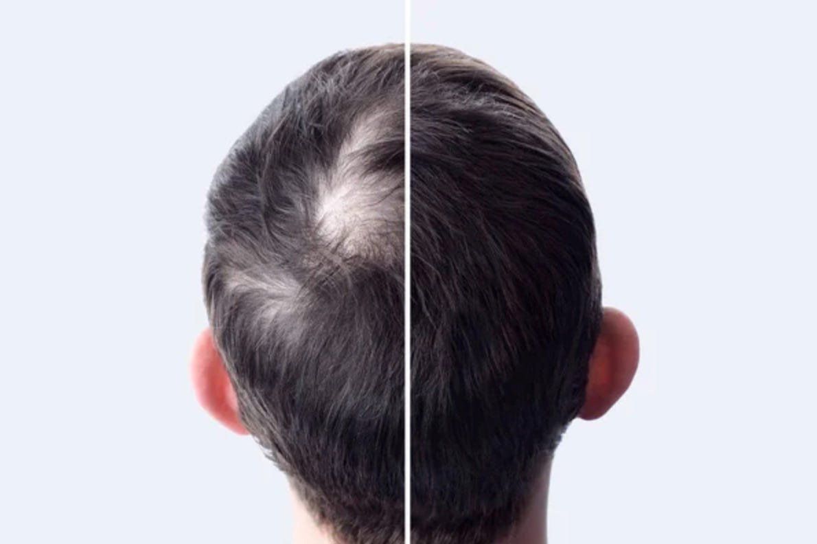Hair Transplant for Crown Area - Harley Street HTC