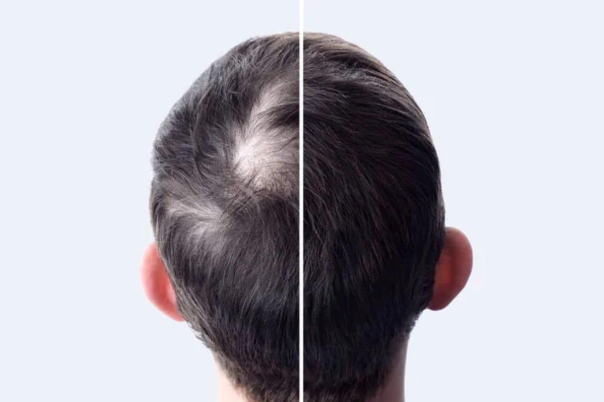 crown hair transplant